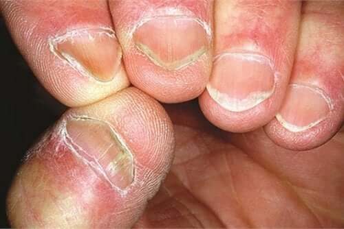 Fingernails with Hallopeau syndrome.