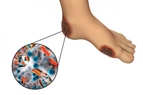 A graphic of gangrene on the foot, showing bacteria.