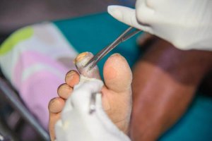 Types of Gangrene: What It Is and What Causes It