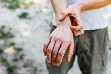 A person itching their wrist.