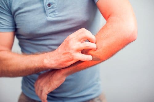 Man scratching itchy arm. Itchiness is one symptom of tungiasis.