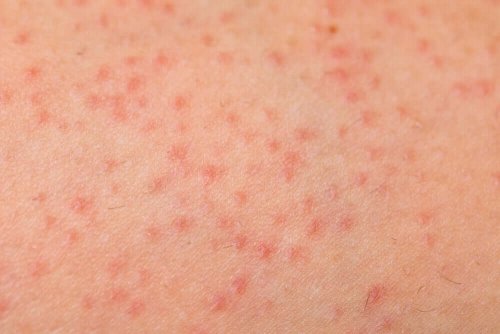 A close up of keratosis pilaris bumps on skin.