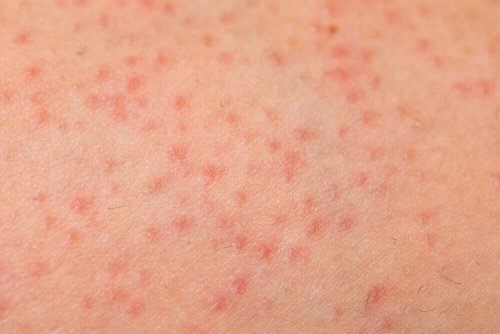 Keratosis pilaris