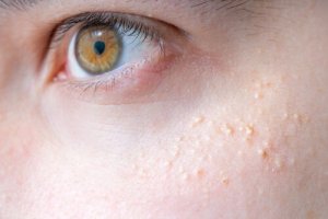 Keratosis Pilaris and Natural Remedies