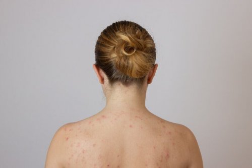 The Cause of Fatty Lumps on the Back - Step To Health