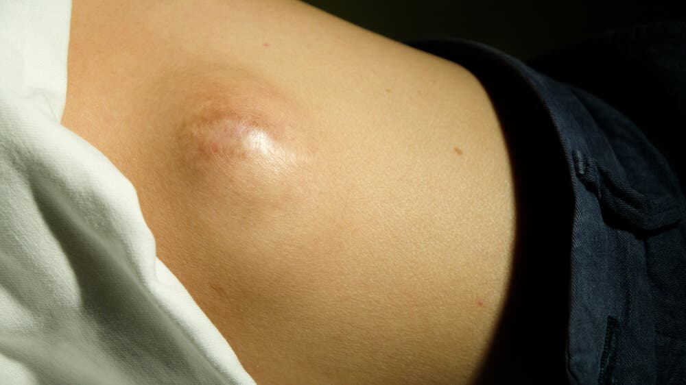 A woman with a lipoma.