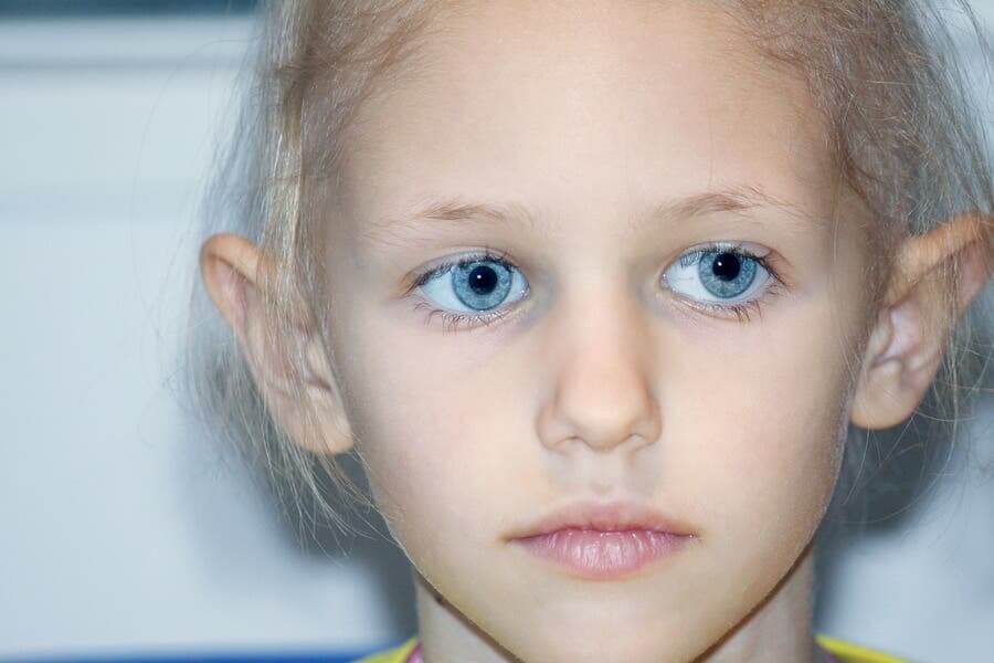 A child with retinoblastoma.