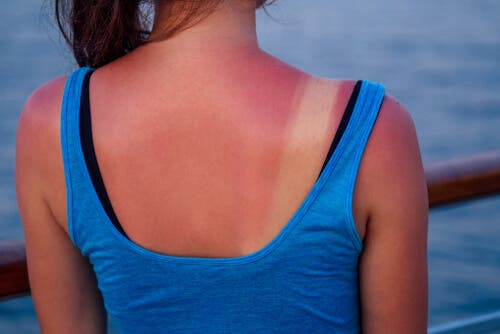 A girl with a sunburn.