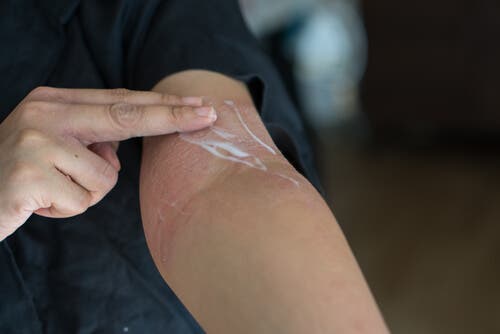 A person using topical corticosteroids on his arm.