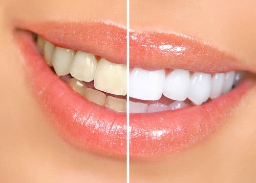 A picture showing the results of teeth whitening.