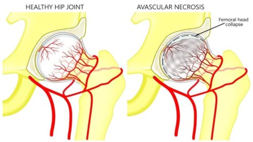 Femoral Head Avascular Necrosis