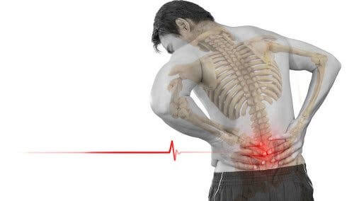 Man with x-ray image of skeleton holding lower back in pain from spondylolisthesis.