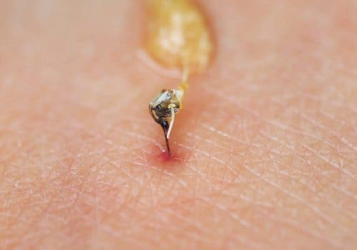 A bee's stinger stuck in the skin.