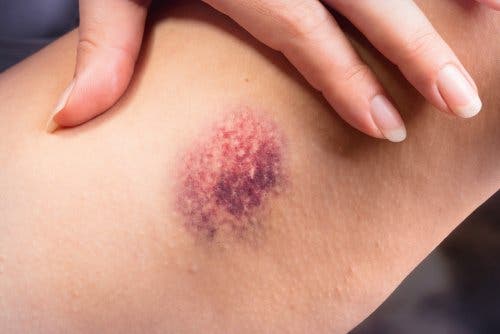 A bruise on a leg, caused by superficial thromboflebitis.