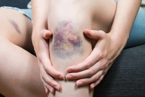 What Causes Superficial Thrombophlebitis?