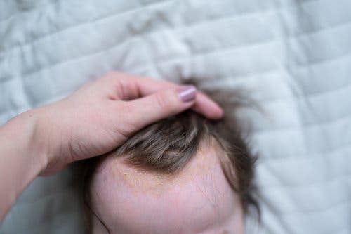Holding baby's hair back to show cradle cap on scalp.