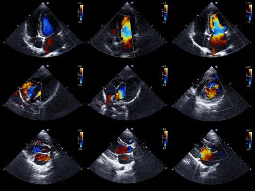Images from an echocardiogram, one measure to detect a pericardial effusion.