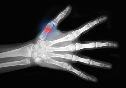 Deglo Degloving Injuries: What Are They and How Are They Classified?