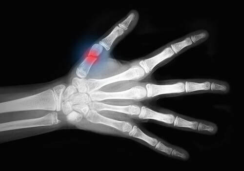 A hand X-ray showing a fracture.