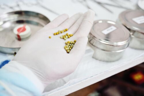 Gallstones in a doctor's hand.