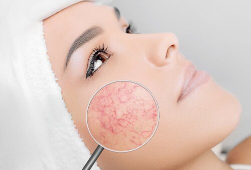 6 Things You Should Avoid if You Have Rosacea