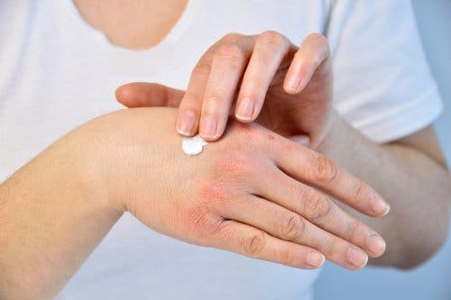 Person applying hand cream for a bee sting.