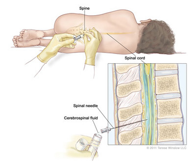Lumbar puncture.