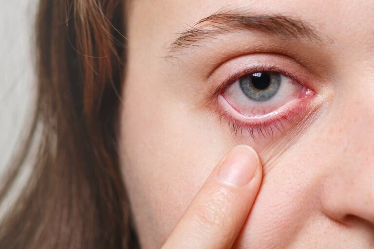 5 Effective Remedies for Eye Infections