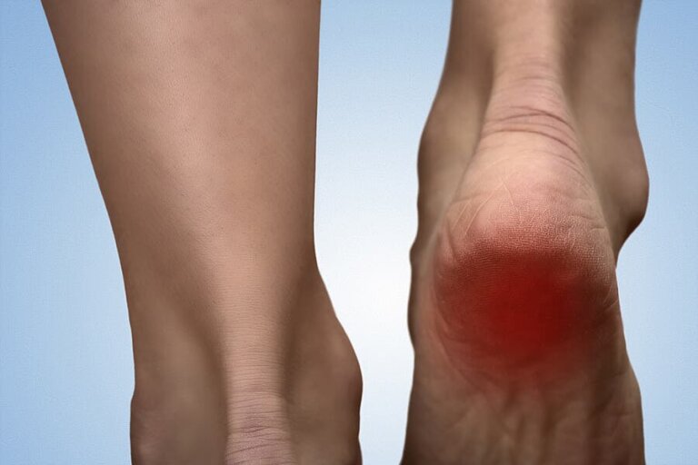 5 Remedies for Heel Spur