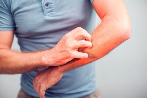 5 Natural Remedies to Relieve Itching