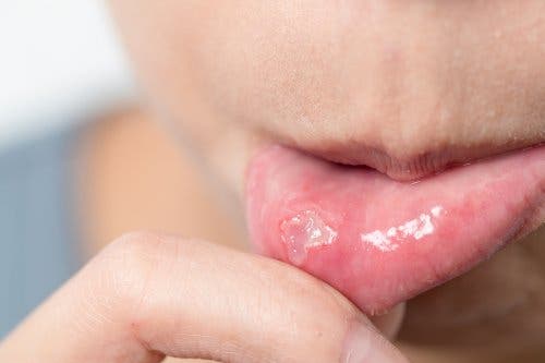 5 Ways to Cure Canker Sores Quickly