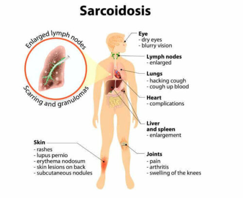What Is Sarcoidosis? Symptoms and Treatment