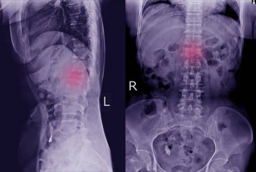 Two images of a spine x-ray.