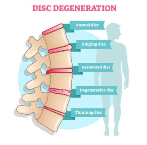 Symptoms of Degenerative Disc Disease