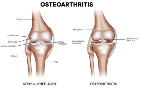 A drawing of hip osteoarthritis.