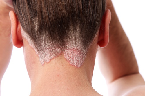 A person with scalp psoriasis.