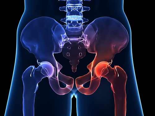 Hip Osteoarthritis – Characteristics and Symptoms
