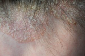 Scalp Psoriasis - Symptoms and Treatment