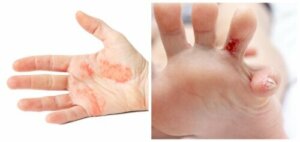 Dyshidrotic Eczema: Everything You Need to Know