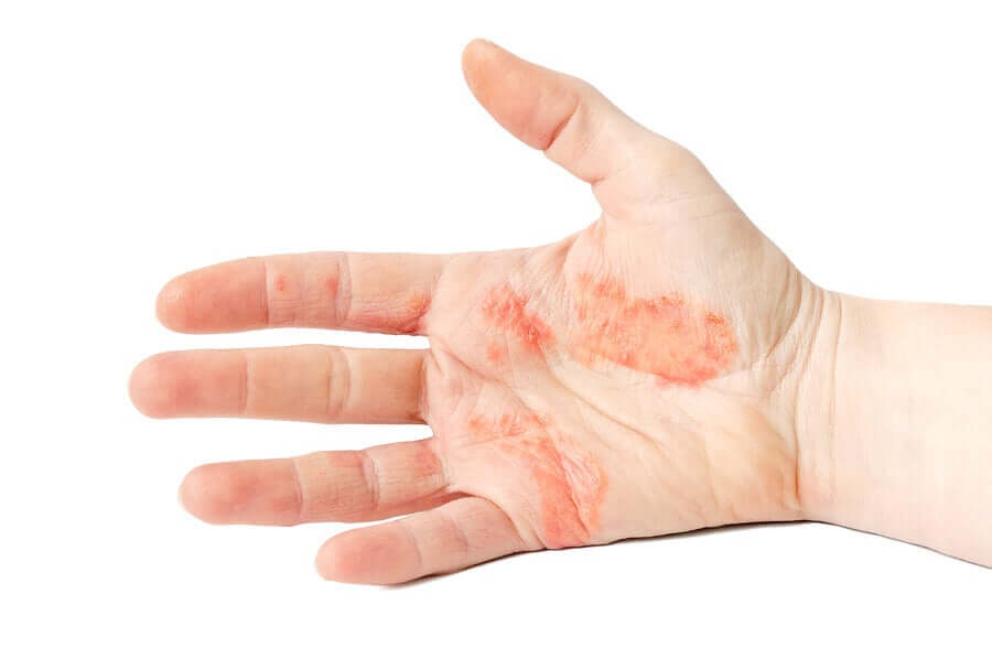 Dyshidrotic eczema of the hands.