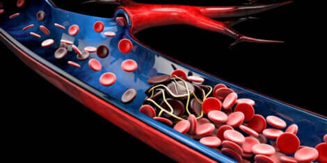 Iron deficiency in the blood.