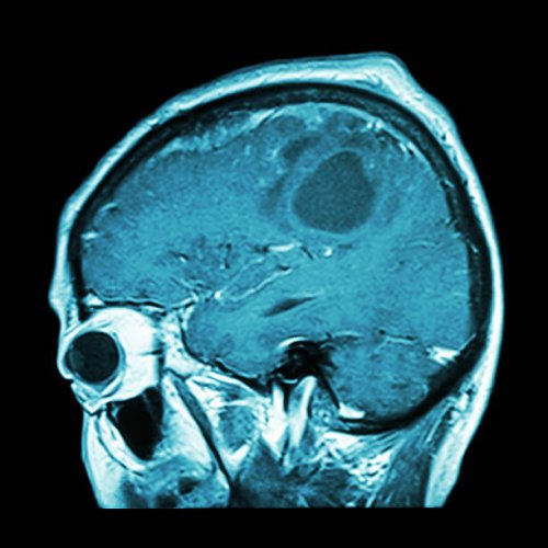 Will a Brain Cancer Vaccine Be Available Soon?