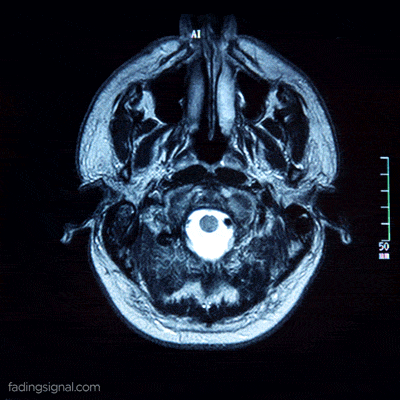 An animated gif of the layers of a brain scan.