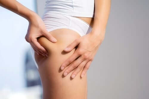 A woman with cellulite.