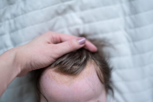 A baby with cradle cap.