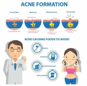 Acne Conglobata: Causes and Symptoms
