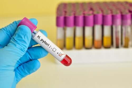 A positive H. pylori test in a vial for diagnosing stomach and duodenal ulcers.
