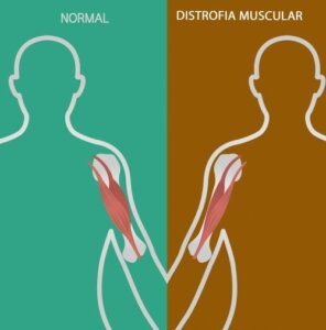 Neuromuscular Disorders: Signs and Symptoms