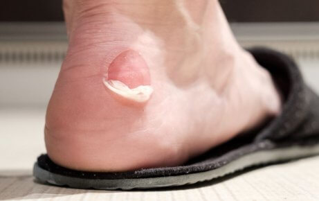 Pop blisters.