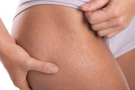 Stretch marks on a thigh.